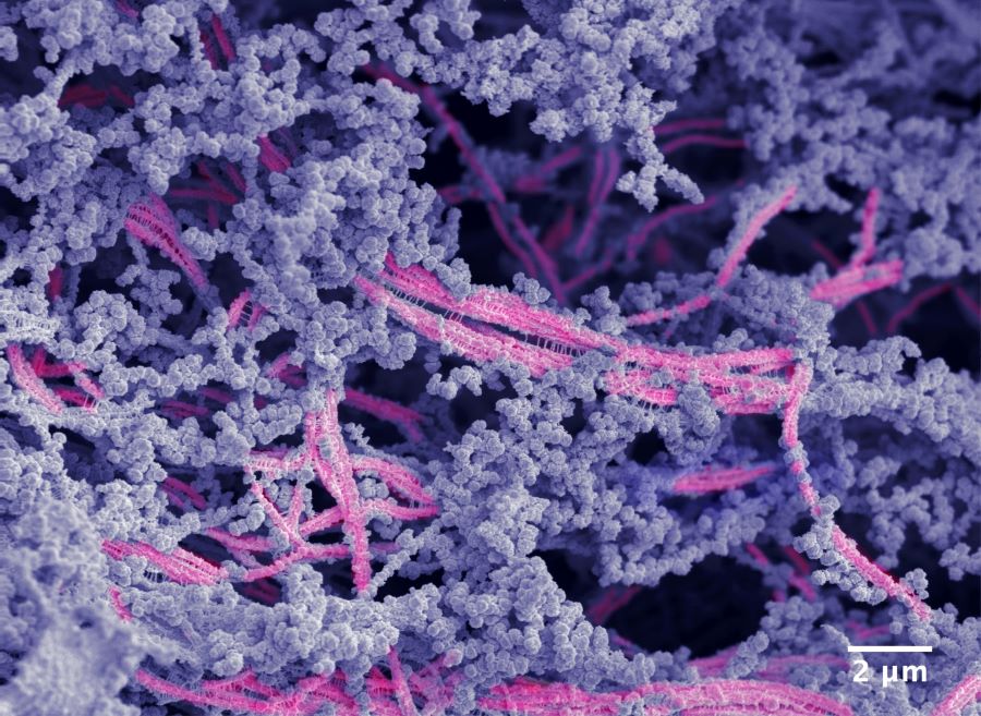 Το νέο βιοϋλικό. Οι νανοΐνες είναι ροζ και το υαλουρονικό οξύ φαίνεται με μοβ χρώμα. CREDIT: Samuel I. Stupp/Northwestern University